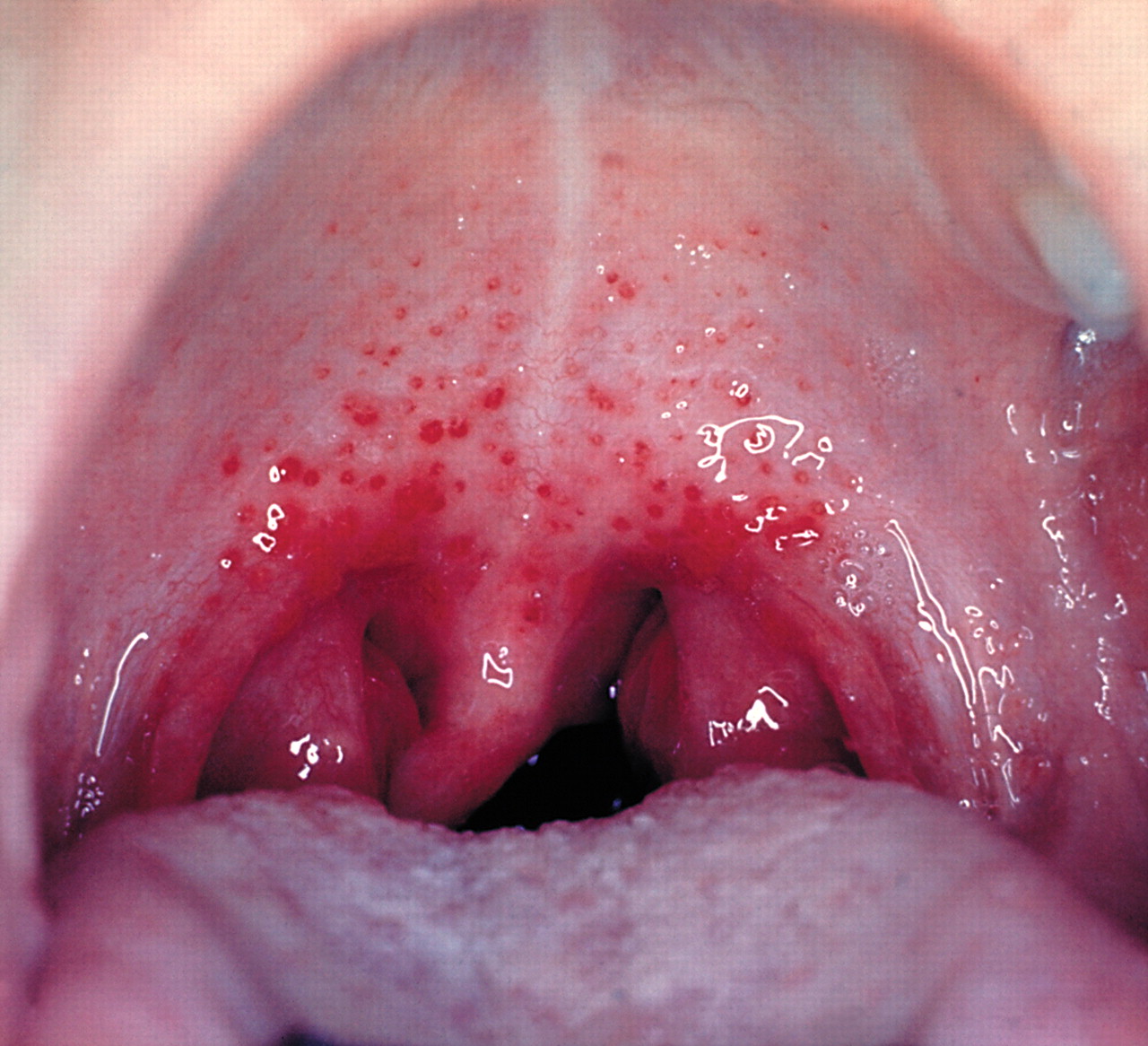 strep a