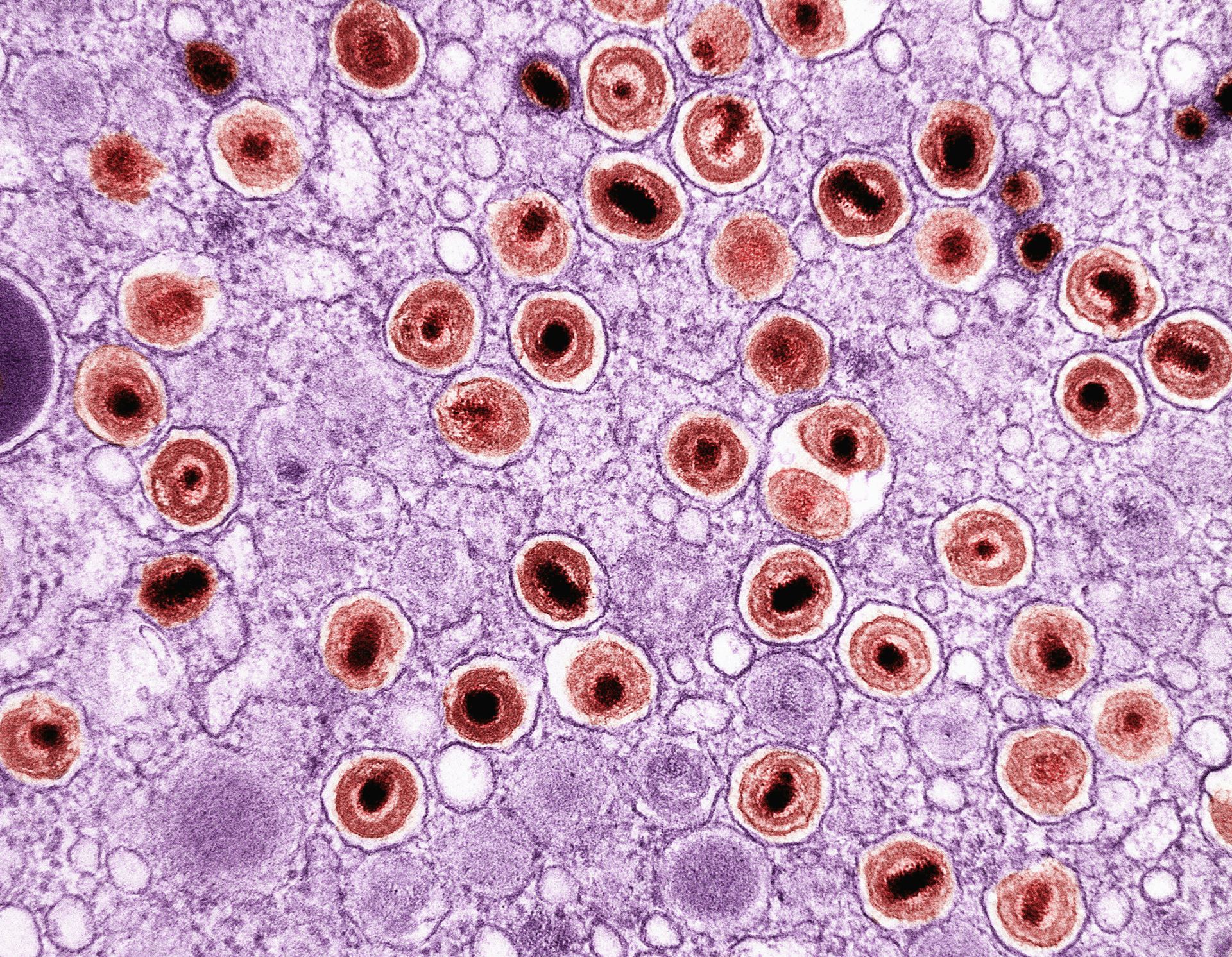 Leginonnaries Disease